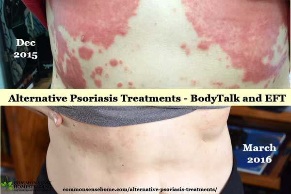 One of the most fundamental alternative psoriasis treatments I used was to change my state of mind using two primary techniques - EFT and BodyTalk.