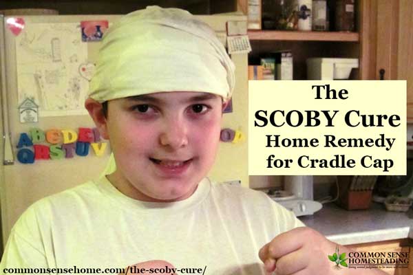 The SCOBY Cure – Home Remedy for Cradle Cap