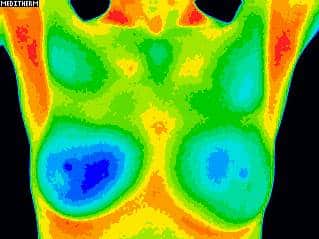 Thermographic image of breast tissue