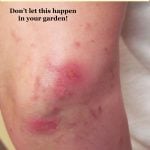 Phytophotodermatitis blisters on elbow