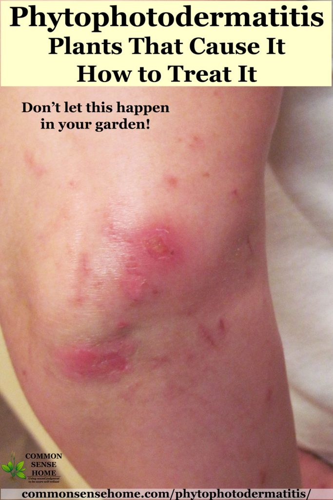 Phytophotodermatitis blisters on elbow