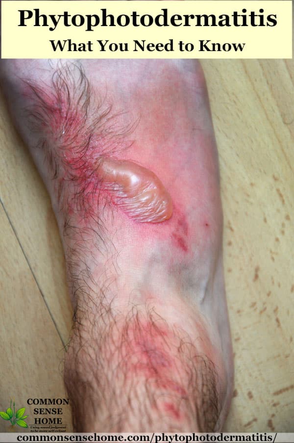 Phytophotodermatitis on foot with large blister
