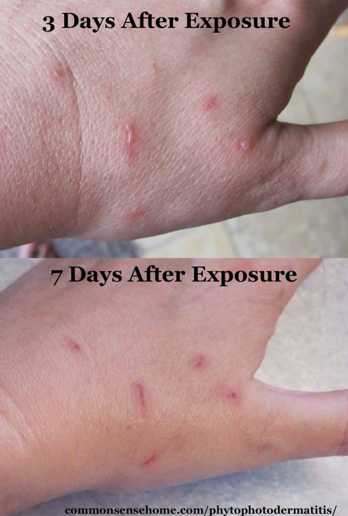 phytophotodermatitis on hand at 3 and 7 days after exposure