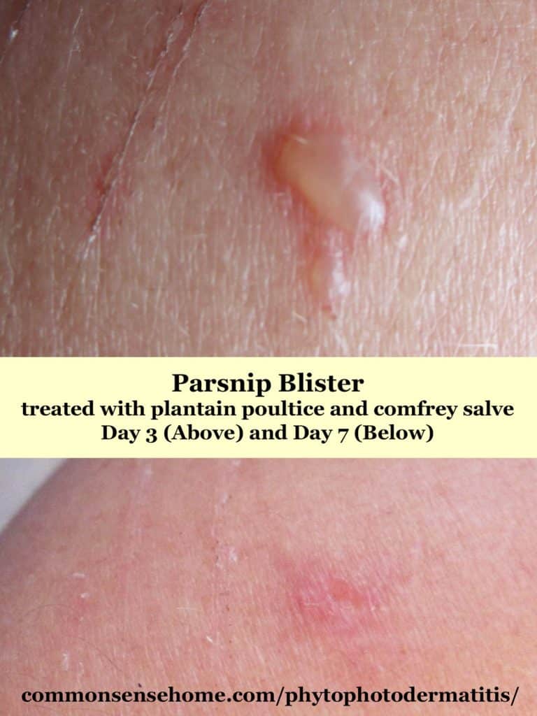 Phytophotodermatitis blister 3 days and 7 days after exposure