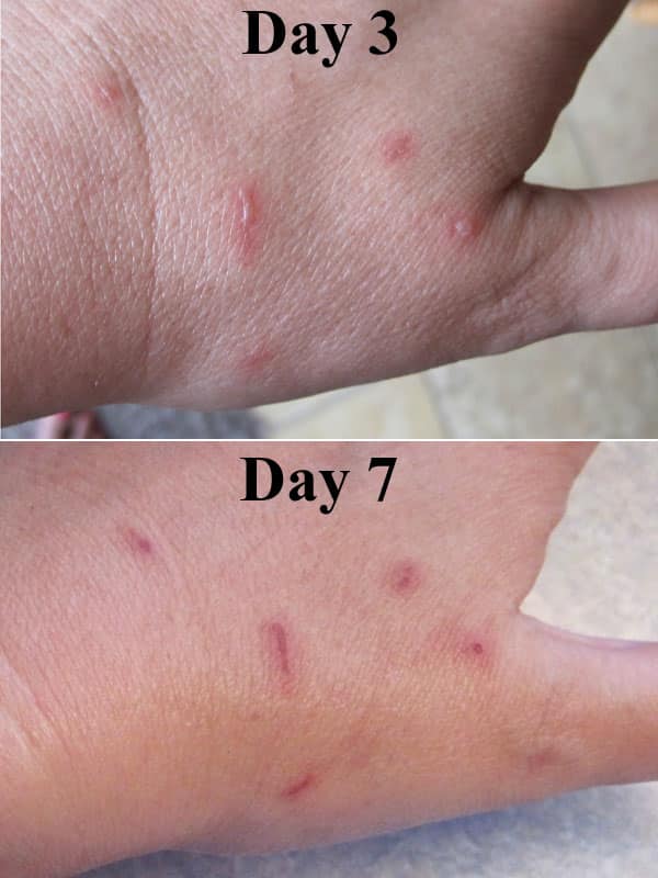 phytophotodermatitis cure