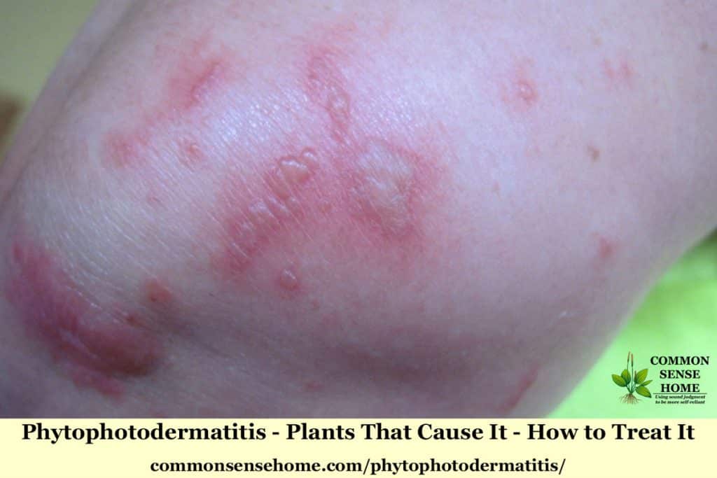 Phytophotodermatitis – Plants That Cause It, How to Treat It