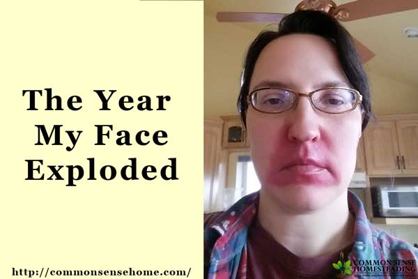 Psoriasis – The Year My Face Exploded