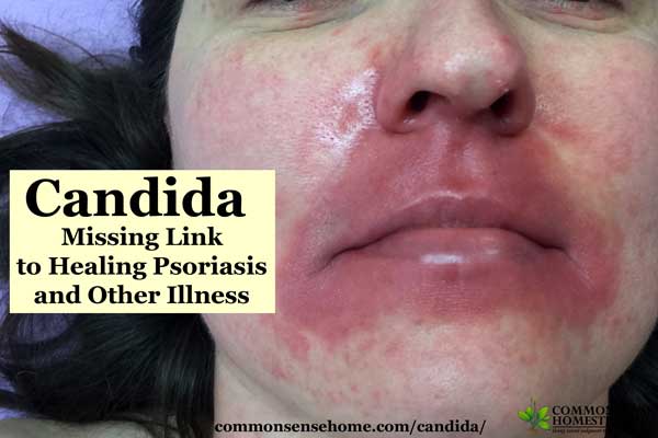 Candida Skin Face