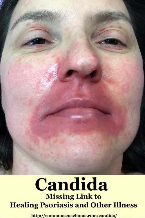 Cutaneous Candidiasis Face