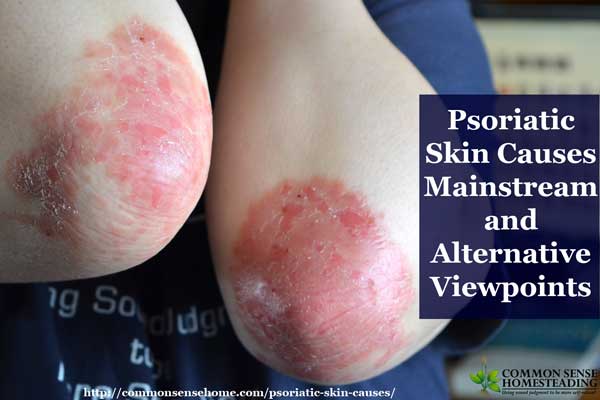 Psoriatic Skin Causes - Mainstream and Alternative Viewpoints on the underlying causes of psoriasis including lifestyle, diet, toxins, injury and medication