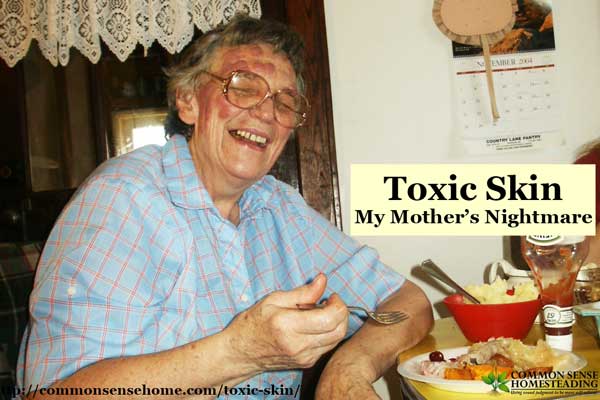 Toxic Skin – My Mother’s Nightmare