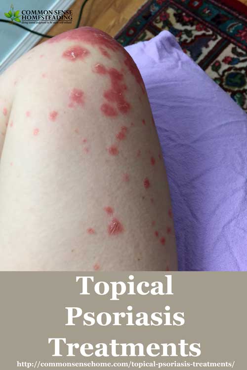 topical treatments