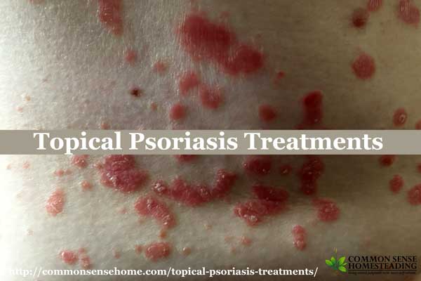 Topical Psoriasis Treatments – Relief for Dry, Flaking Skin