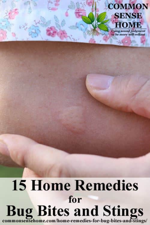 15 Home Remedies For Bug Bites And Stings For Mosquito Bites And More 0791