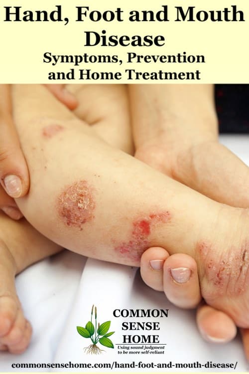 hand foot and mouth disease