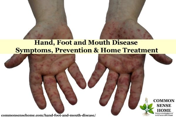 Hand, Foot and Mouth Disease – Symptoms, Prevention and Home Treatment