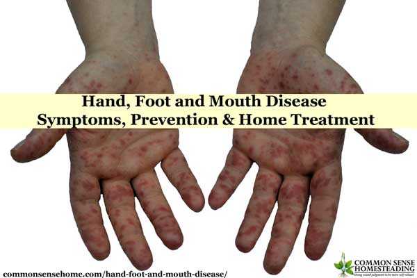 Hand Foot and Mouth Disease - Spot it, Avoid it, Treat it