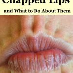 Whether they're caused by too much dry air or medical conditions, chapped lips can be uncomfortable. With a little TLC, you can treat and repair dry lips.