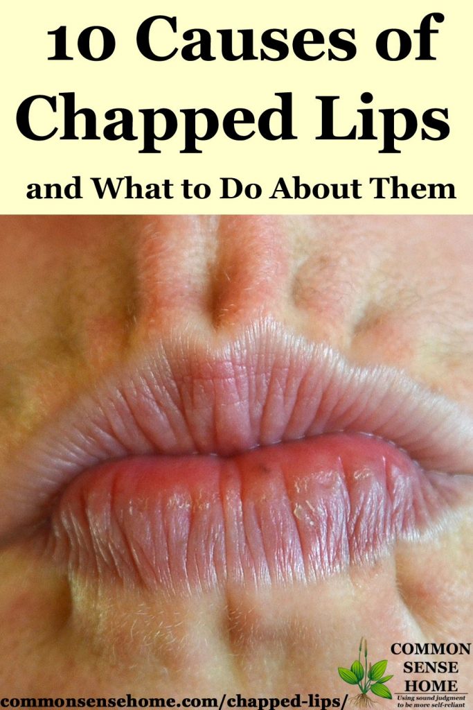 Close-up picture of chapped lips