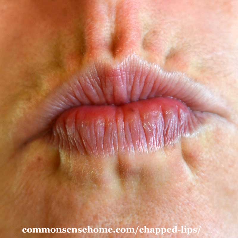 10 of Chapped Lips, Plus How Get Rid of Chapped