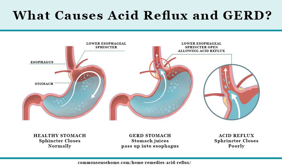 Homesteading Alliance 10 Home Remedies For Acid Reflux And The Problem 