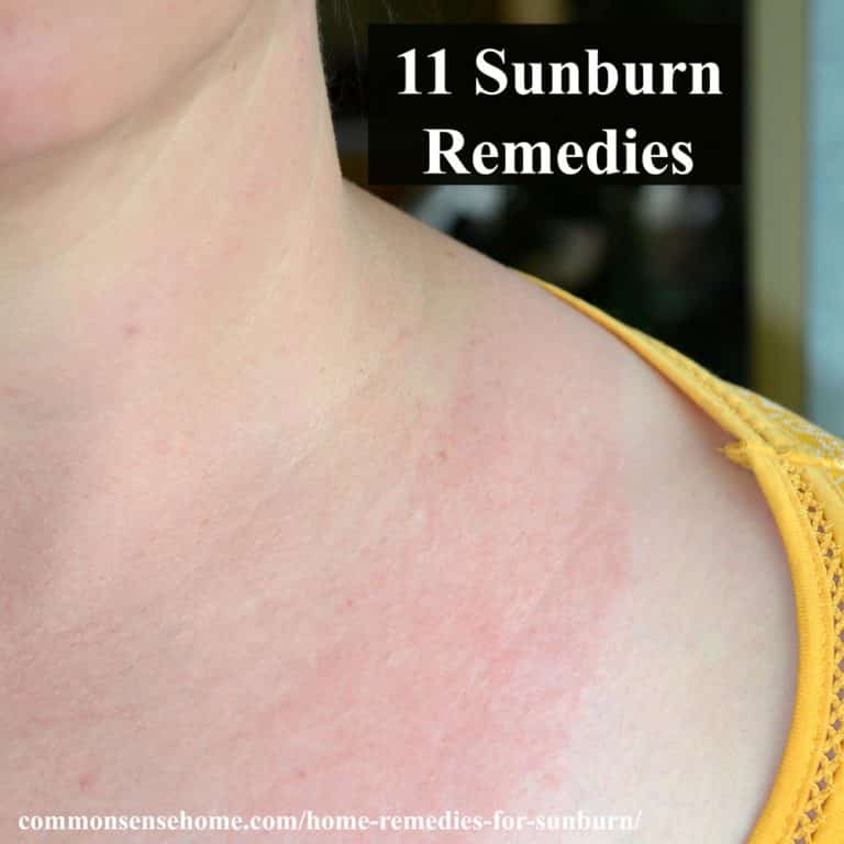 sunburned neck and chest with text overlay "11 sunburn remedies"