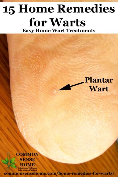 Plantar wart on bottom of foot