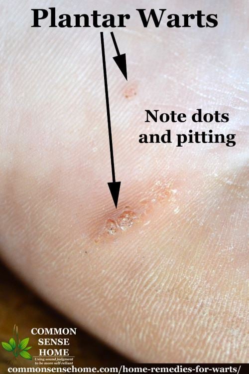 Plantar wart close-up