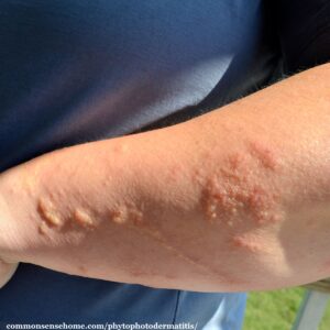 phytophtodermatitis on arm