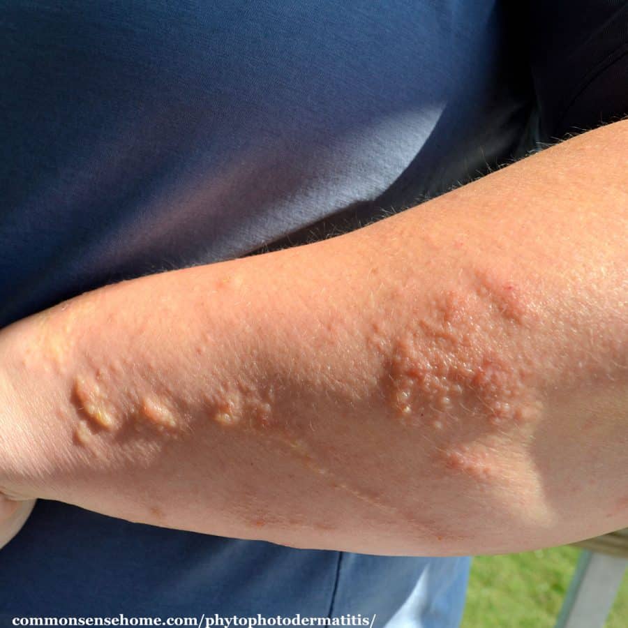 phytophtodermatitis on arm