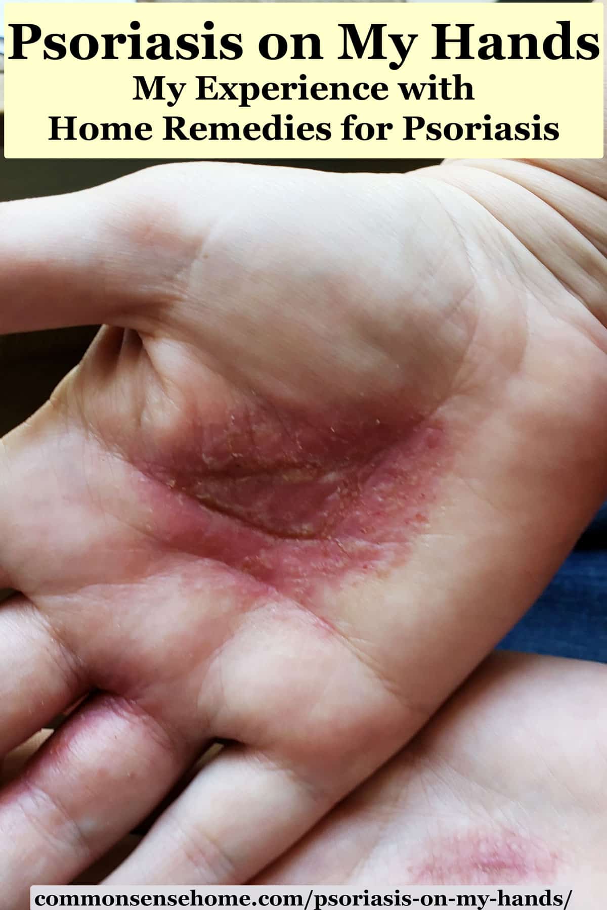 psoriasis-on-my-hands-causes-remedies