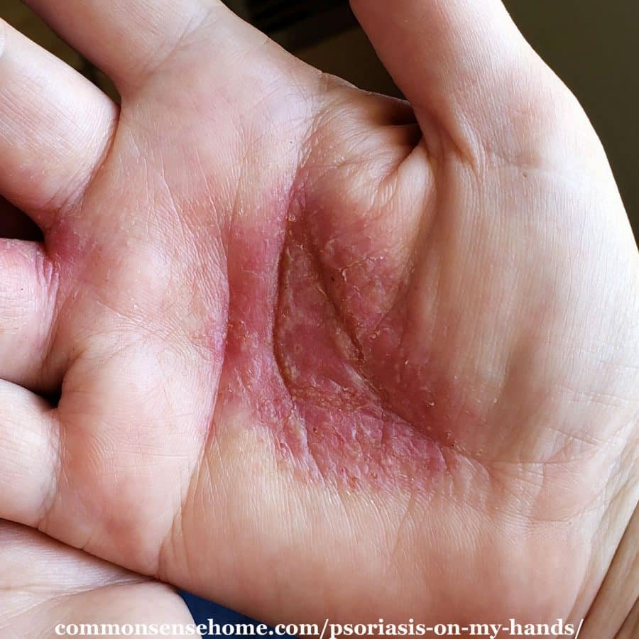 mild psoriasis on hands