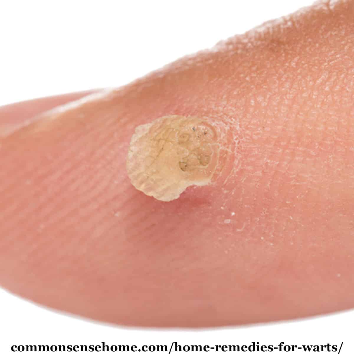 Planters Wart On Hand Removal | Bruin Blog