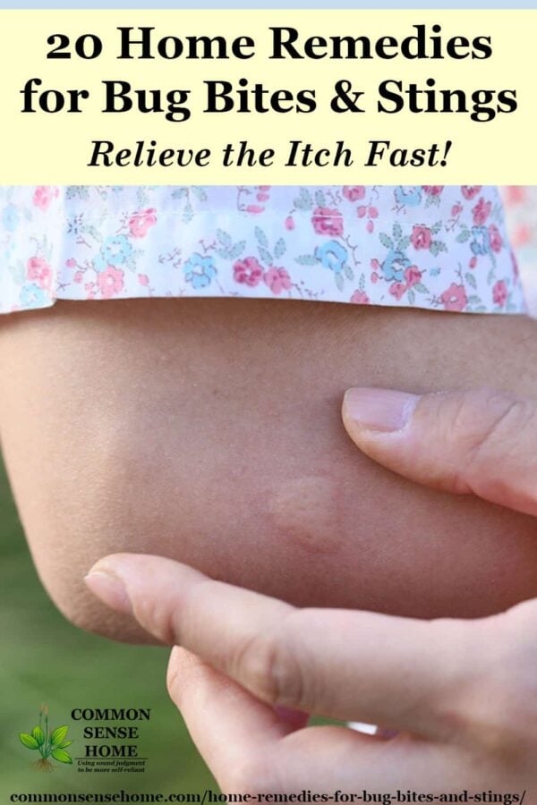 20 Home Remedies For Bug Bites And Stings That Itch Swell