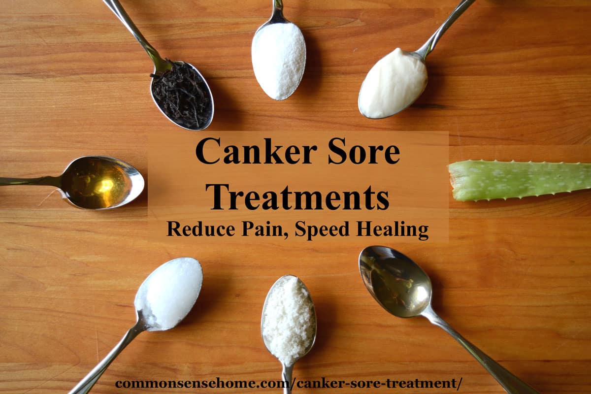 canker sore treatments