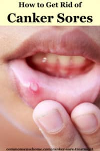 Canker Sore Treatment (how To Get Rid Of Canker Sores)