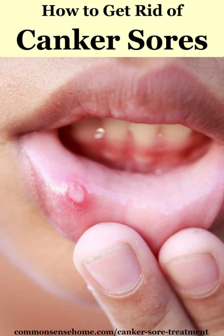 Canker Sore Treatment (How to Get Rid of Canker Sores)