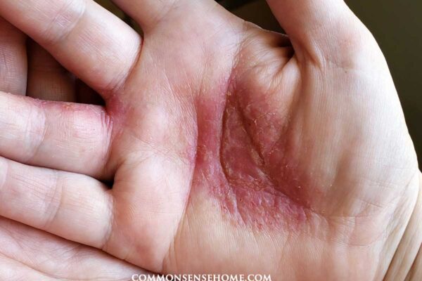 Psoriasis on My Hands - Palmoplantar pustulosis