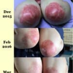 alternative psoriasis treatment elbow comparison