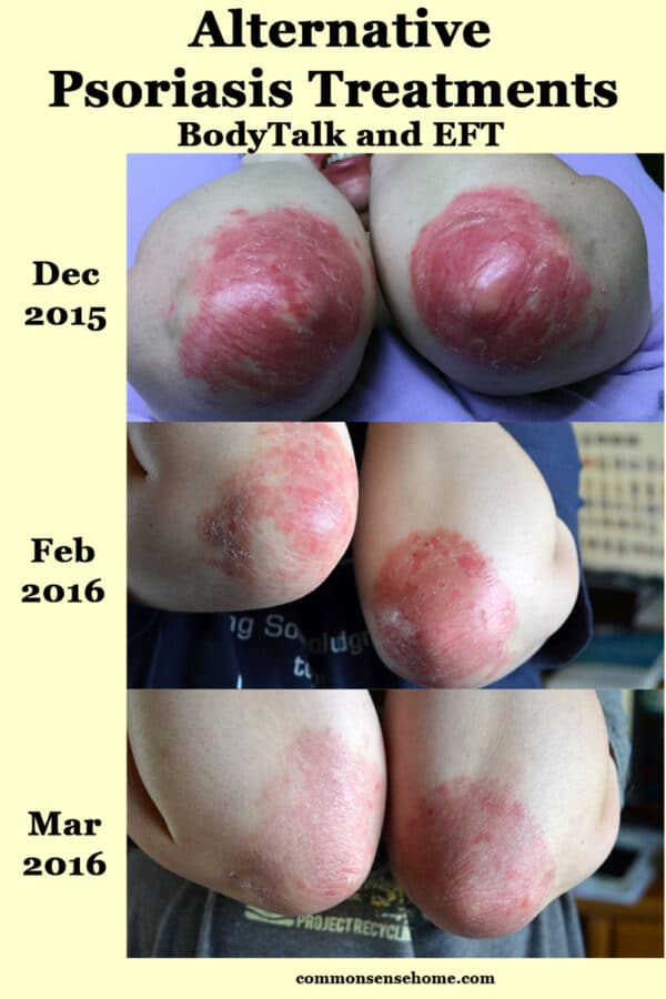 alternative psoriasis treatment elbow comparison