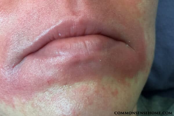 candida overgrowth on face