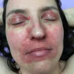 woman's face covered in psoriasis