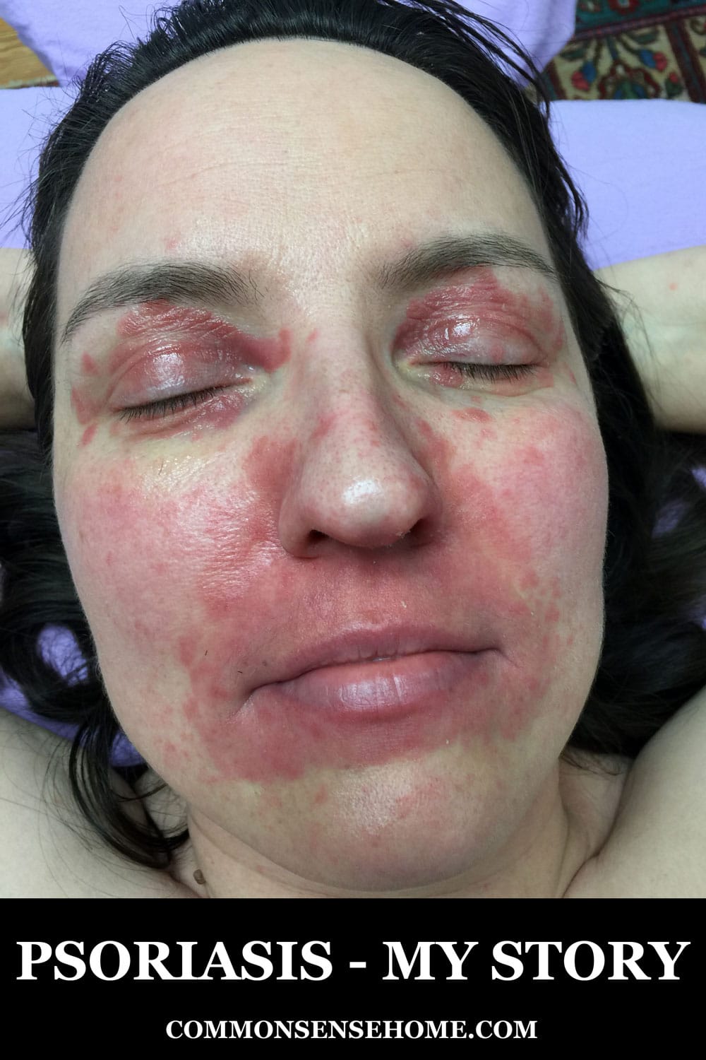 woman's face covered in psoriasis