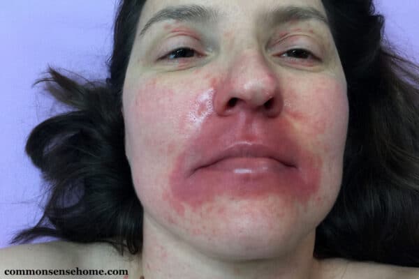 woman with plaque psoriasis on face