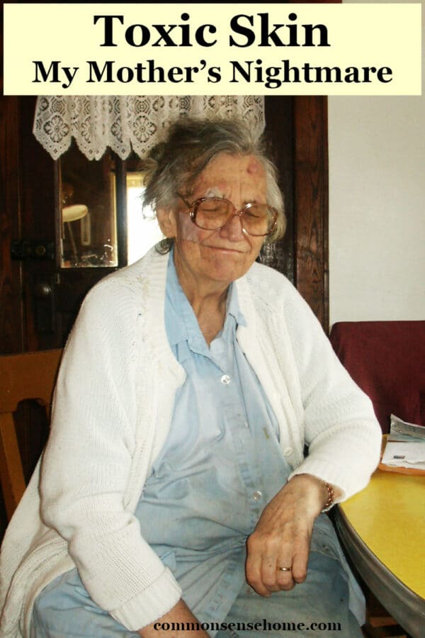 Older woman with lymphocytoma cutis