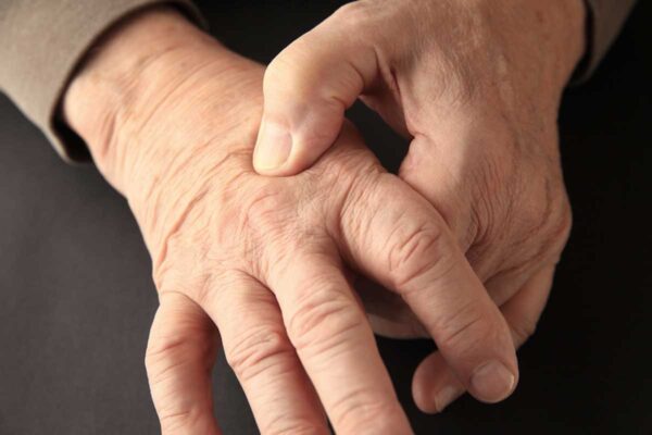 painful arthritis hands