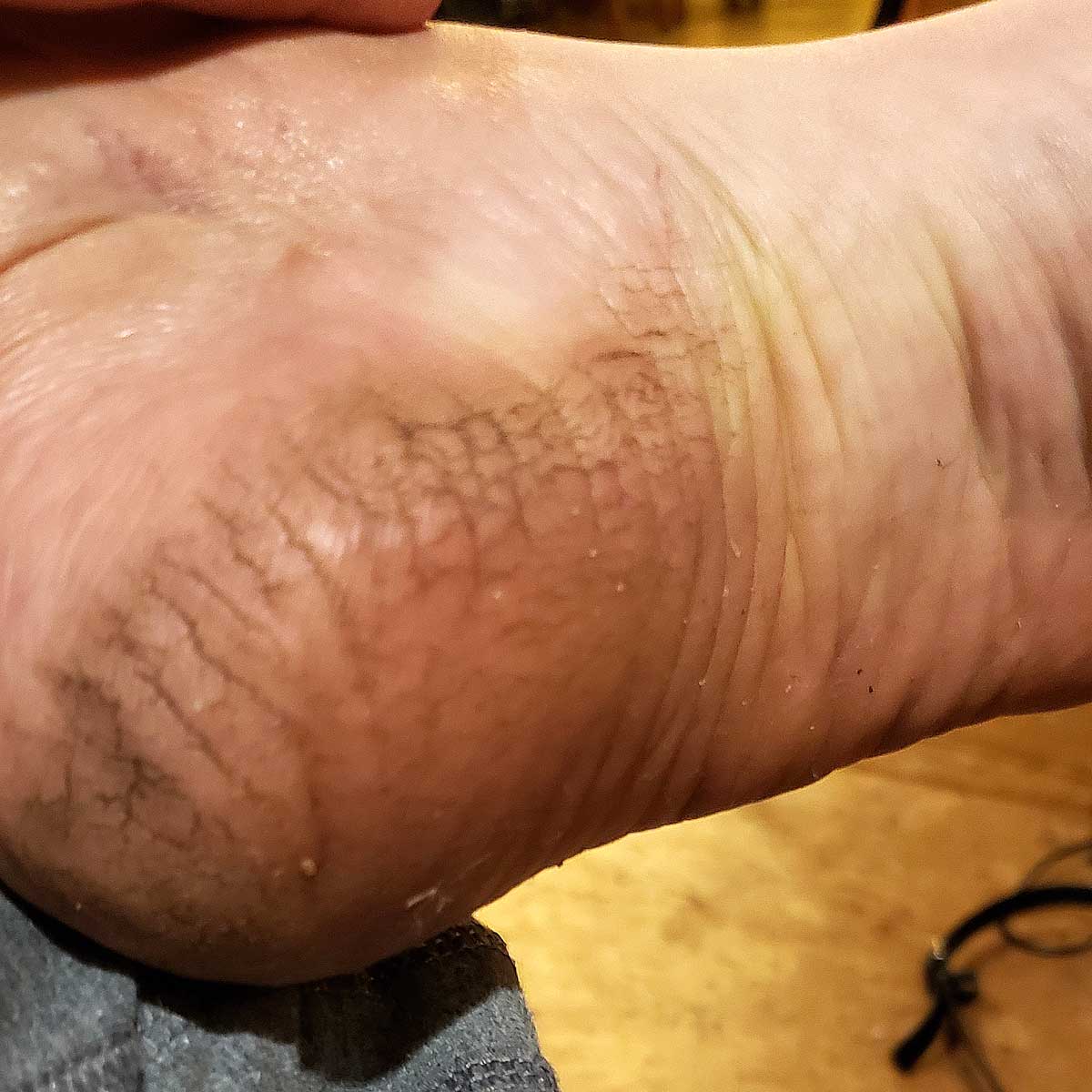 foot with cracked heel