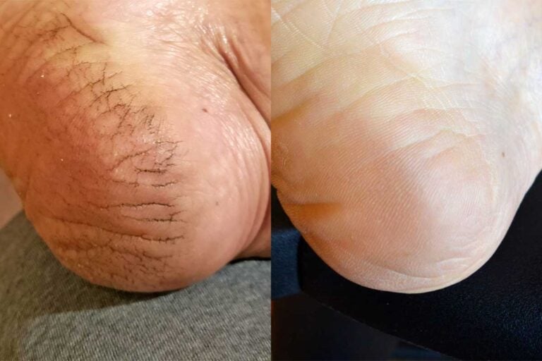 cracked heel (left), healed smooth heel (right)