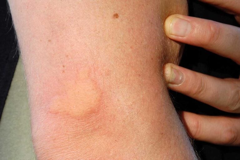 deer fly bite