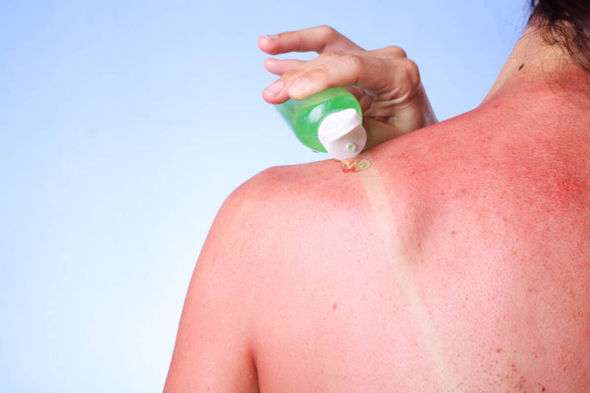 sunburn treatment